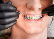 Jak prawidłowo dbać o aparat ortodontyczny?